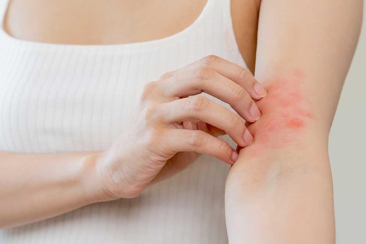 Allergien: Ursachen, Symptome und Behandlungsmethoden