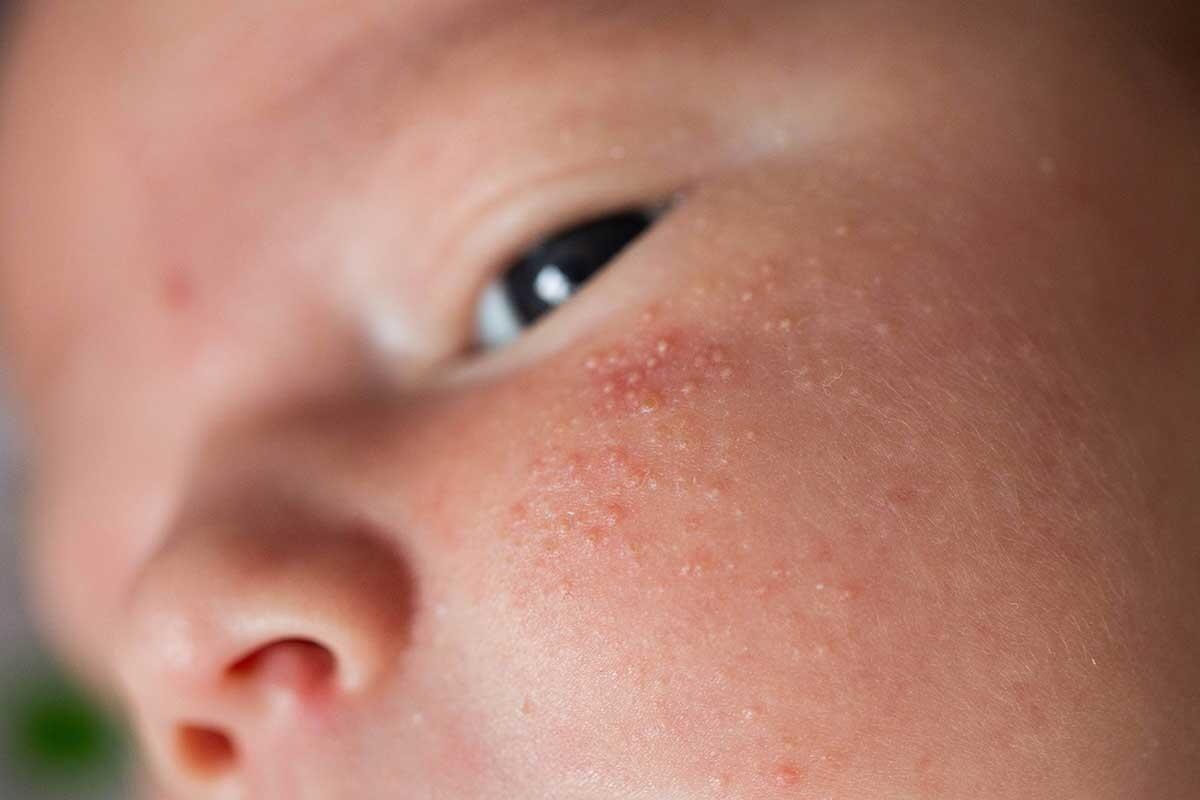 Alles über Hitzepickel (Miliaria): Ursachen, Symptome und wirksame Behandlungen