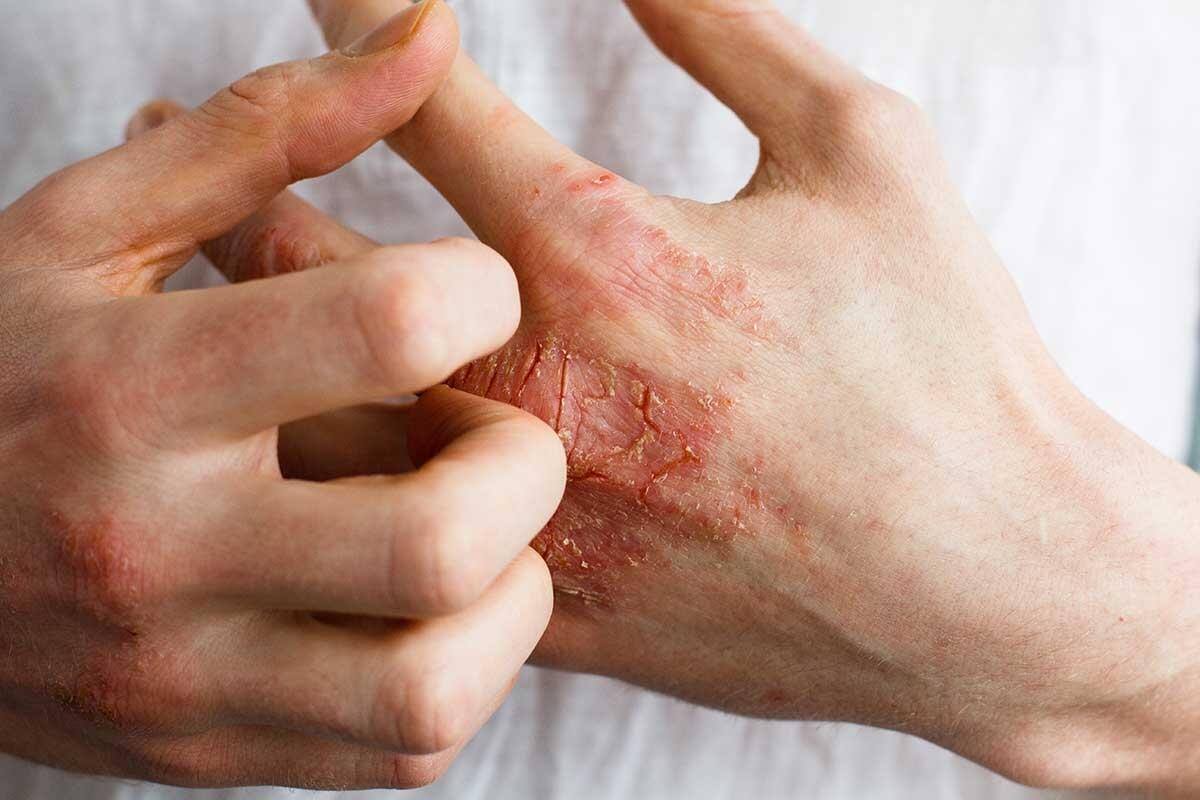 Dermatitis: Kontaktdermatitis und atopische Dermatitis verstehen