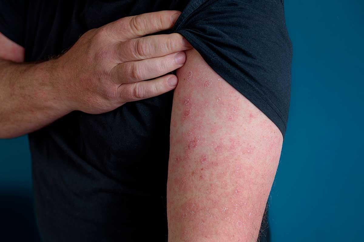 Erysipel: Symptome, Ursachen und wirksame Behandlungen