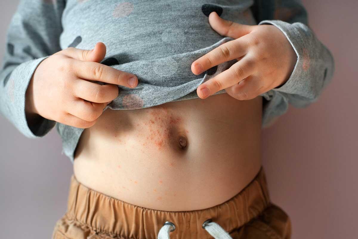Psoriasis verstehen: Ursachen, Symptome und wirksame Behandlungen