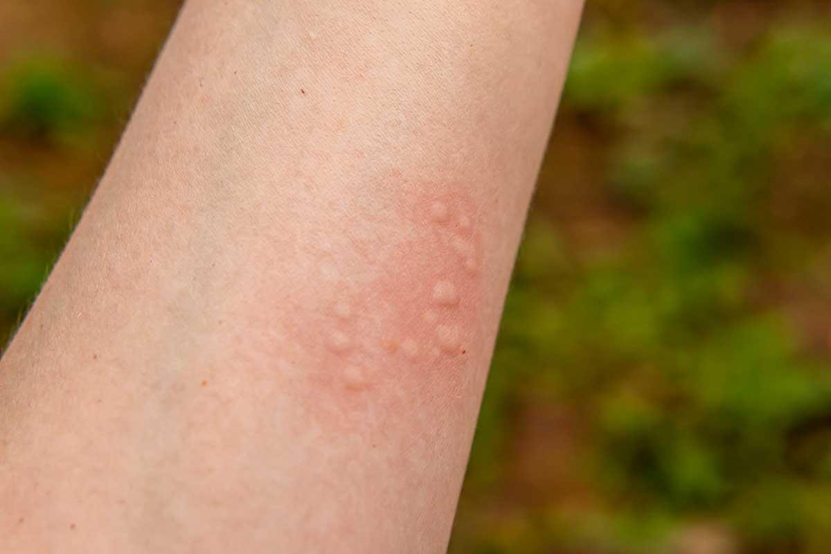 Alles über Nesselsucht: Symptome, Ursachen und Behandlungen