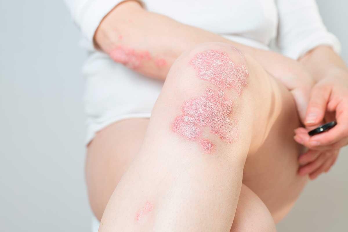 Psoriasis verstehen: Ursachen, Symptome und wirksame Behandlungen
