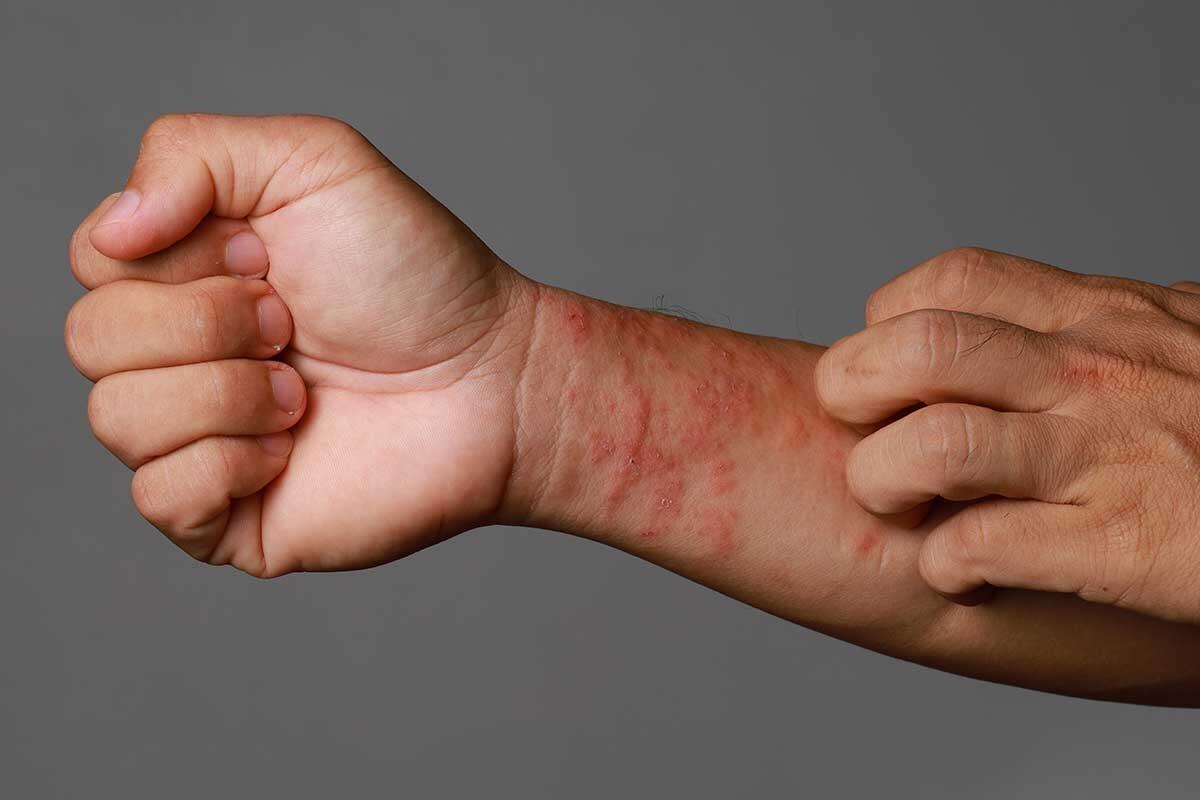 Alles über Ekzeme: Symptome, Ursachen und wirksame Behandlungen